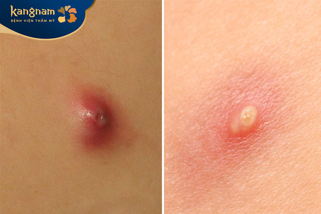 Nốt mụn phát triển và sưng to, có ngòi