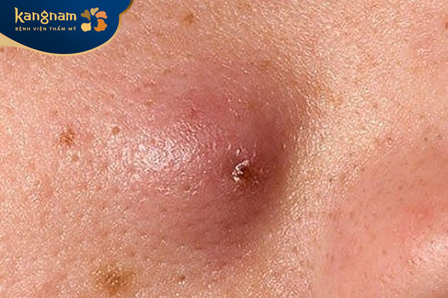 Khi mụn đinh râu có triệu chứng viêm nhiễm như đỏ