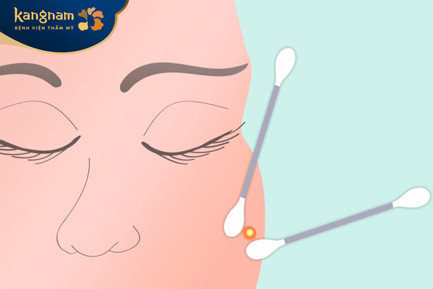 Dùng tăm bông sạch nhẹ nhàng ấn quanh nốt mụn