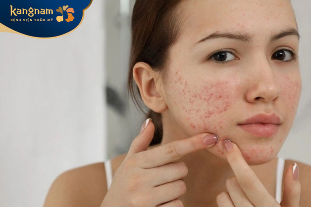 Tự nặn mụn bọc không đảm bảo vệ sinh dễ dẫn đến viêm nhiễm