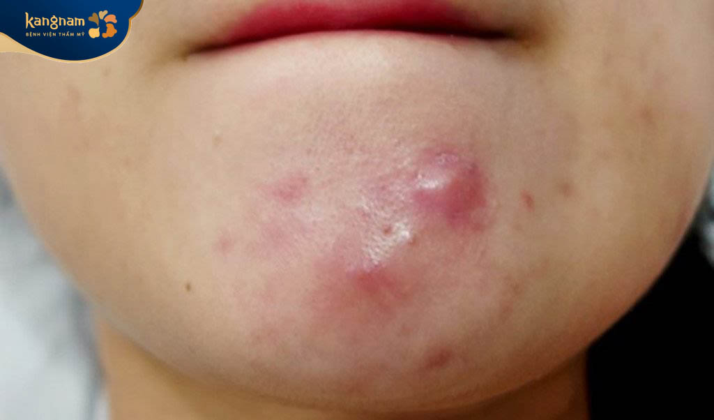 Mụn bọc không đầu là một dạng mụn trứng cá