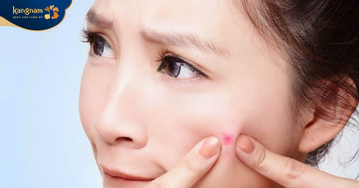 Không nên nặn mụn bọc