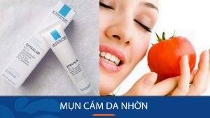 Cách trị mụn cám da nhờn DỨT ĐIỂM tại nhà – Hiệu quả SAU 1 TUẦN
