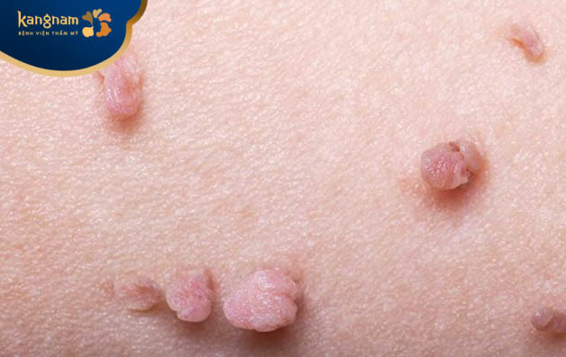 Nguyên nhân gây ra mụn cóc trên bụng