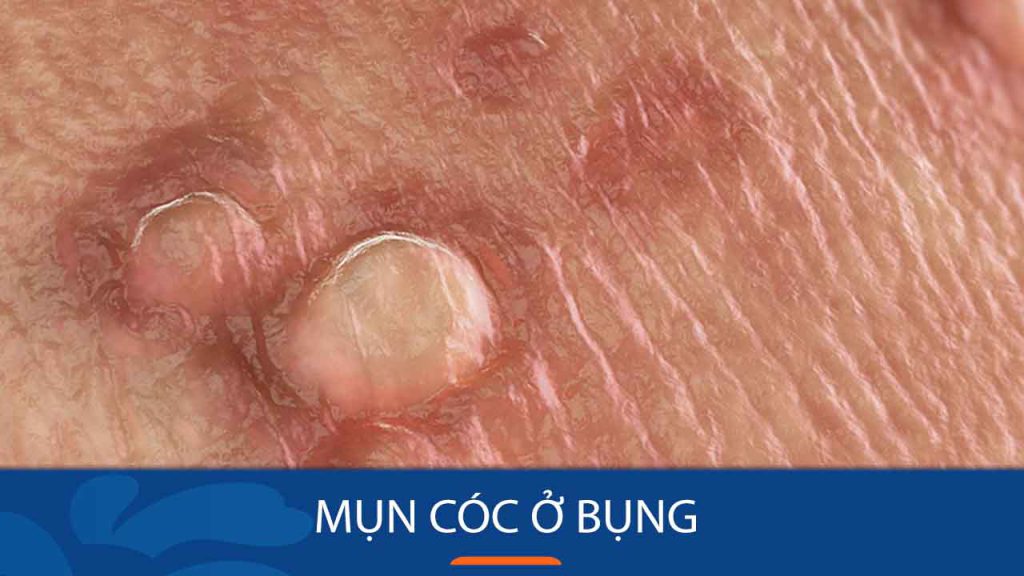 Mụn cóc ở bụng: Hình ảnh và cách chữa trị hiệu quả