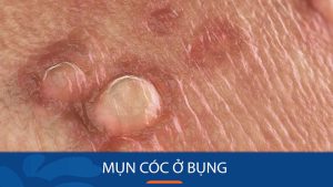 Mụn cóc ở bụng: Hình ảnh và cách chữa trị hiệu quả