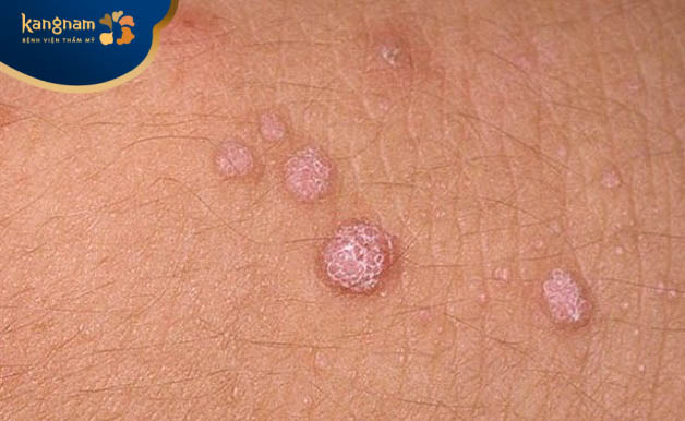 Mụn cóc trên bụng có gây ngứa và đau không?