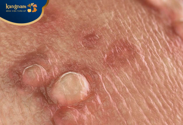 Vì sao mụn cóc mọc ở bụng?