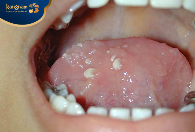 Mụn cóc mọc ở lưỡi có gây đau và khó chịu không?