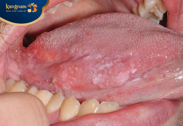 Mụn cóc mọc ở vị trí lưỡi có thể là biểu hiện của sùi mào gà