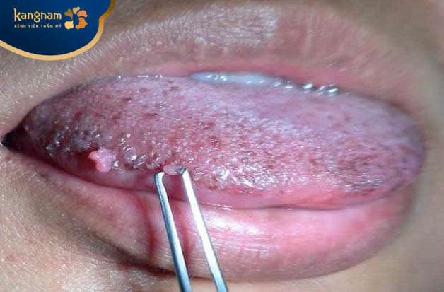 Vì sao mụn cóc mọc ở lưỡi?