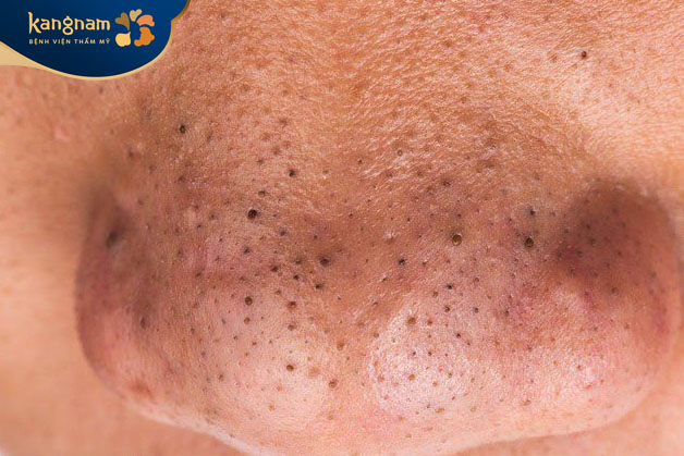 Mụn đầu đen có thành nốt ruồi không