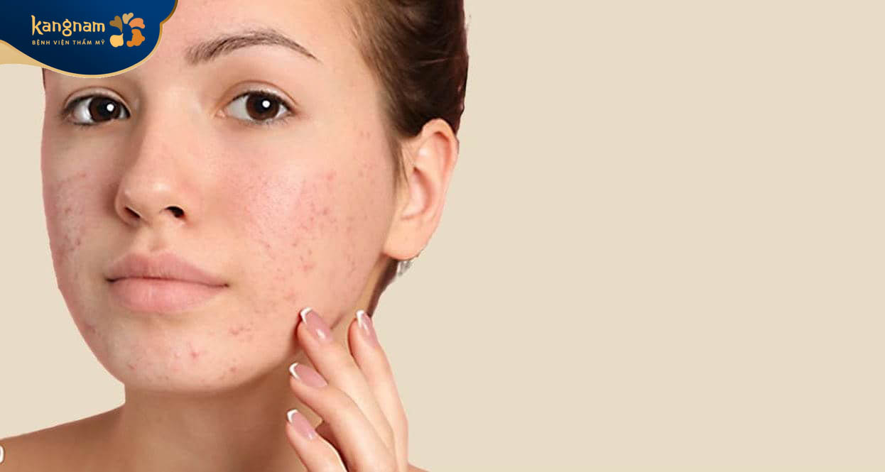 Mụn đầu đen không thể tự hết được