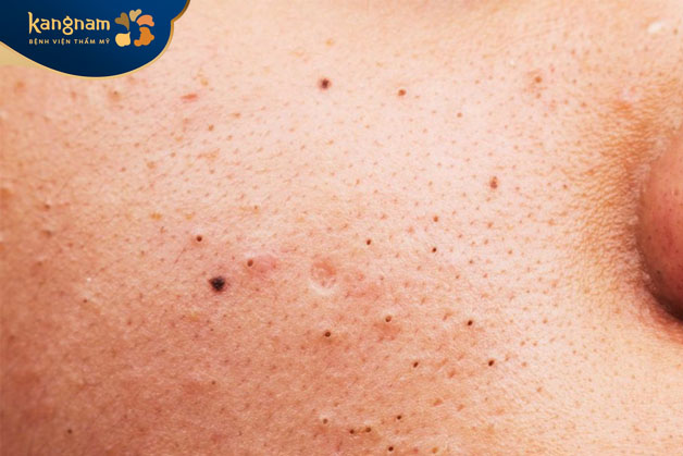 Mụn đầu đen hình thành do lỗ chân lông trên da bị tắc nghẽn