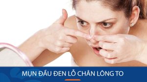 8 Cách Triệt Phá Mụn Đầu Đen & Se Khít Lỗ Chân Lông TO Tự Nhiên – Bí Quyết Da Mịn Màng Không Tì Vết