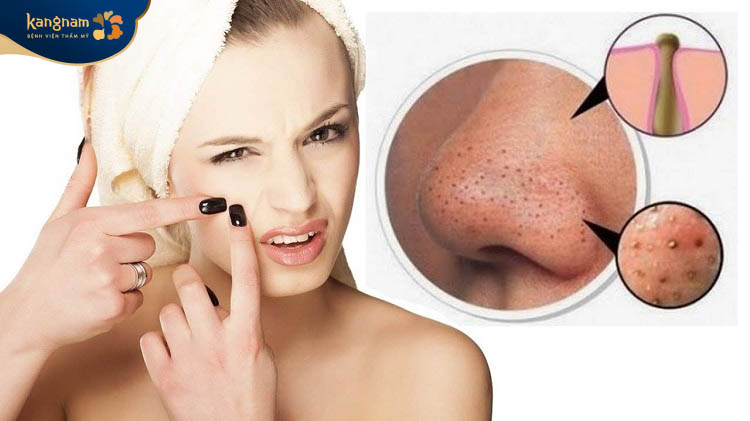 Mụn đầu đen và lỗ chân lông do nhiều yếu tố gây ra