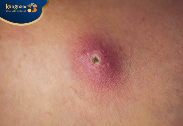 Nguyên nhân làm hình thành mụn