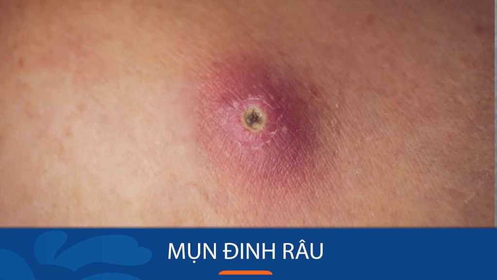 Mụn đinh râu: Nguyên nhân, triệu chứng và cách điều trị hiệu quả