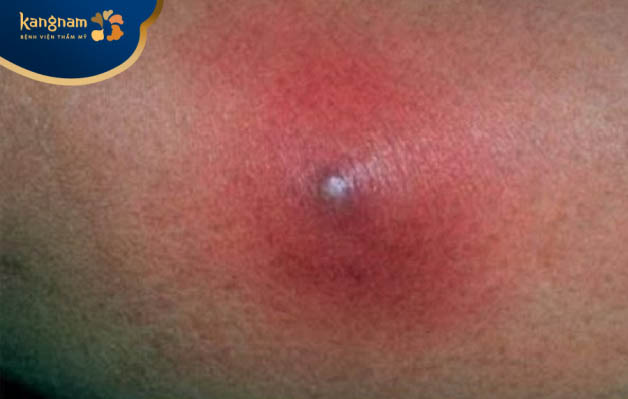 Mụn mủ đinh mọc ở mặt