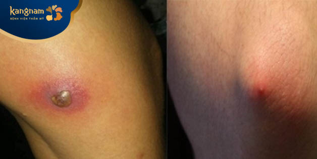 Mụn mủ đinh mọc ở tay