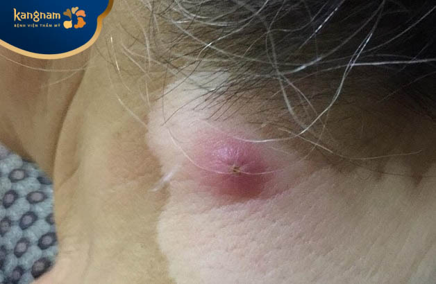 Giai đoạn mủ hóa của mụn