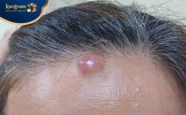 Mụn mủ đinh mọc trên trán 