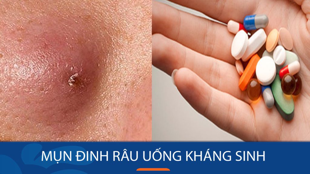 Mụn đinh râu uống kháng sinh gì? Lưu ý khi sử dụng thuốc kháng sinh trị mụn đinh râu