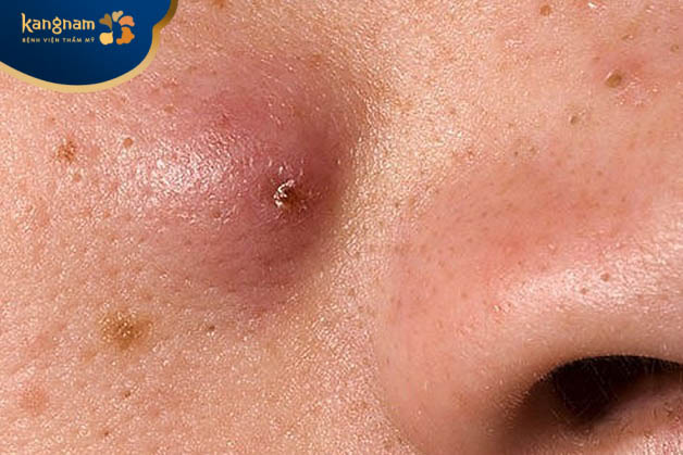 Vì sao gọi là mụn mủ đinh râu?