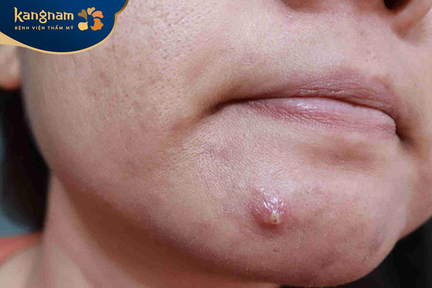 Mụn mủ sẽ chín sau khoảng 5-6 ngày