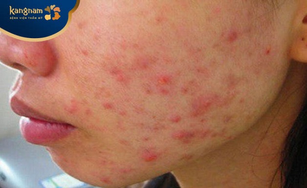 Có nên chờ mụn mủ tự hết không?