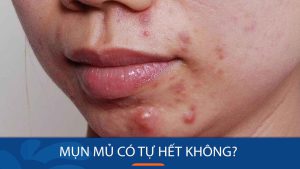 Mụn mủ có tự hết không? có cần bôi thuốc không