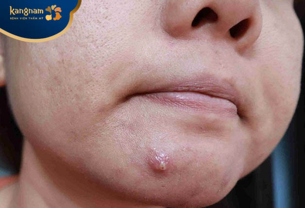 Lỗ chân lông bị tắc nghẽn khiến hình thành mụn mủ và sưng to