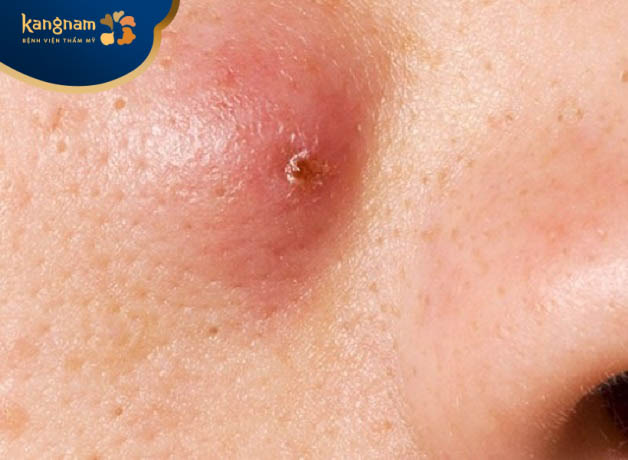 Mụn mủ bị sưng to có đầu đỏ khi mới mọc