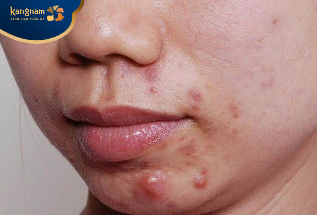 Hình ảnh mụn mủ bị sưng to