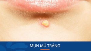Mụn mủ trắng là gì? Cách trị mụn mủ trắng hiệu quả tại nhà