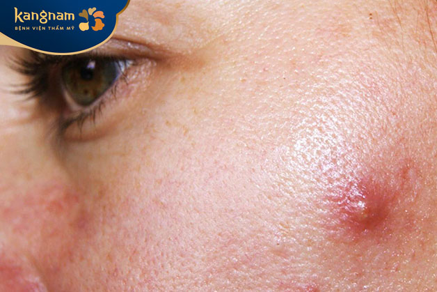 Tình trạng mụn nang thường gây đau, ngứa, sưng tấy