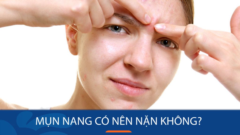 Mụn nang có nên nặn không? Hậu quả khôn lường nếu nặn sai cách!