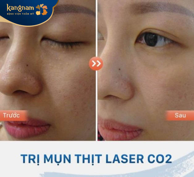 Công nghệ trị mụn thịt Laser Co2 Fractional