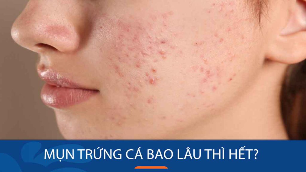 Mụn trứng cá bao lâu thì hết? Loại bỏ mụn trứng cá hoàn toàn chỉ sau 4 tuần?