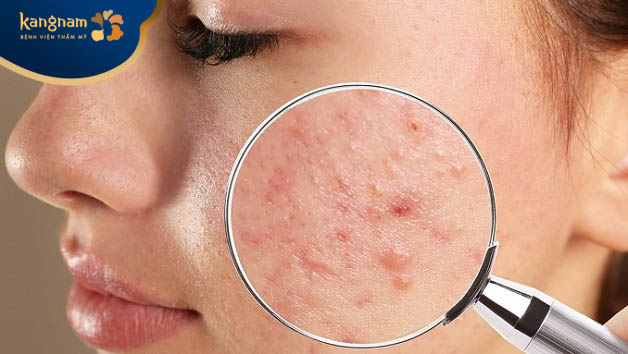 Mụn trứng cá trên vùng da mặt