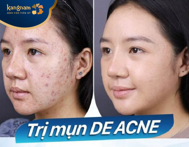 Ứng dụng công nghệ cao De Acne trong trị mụn