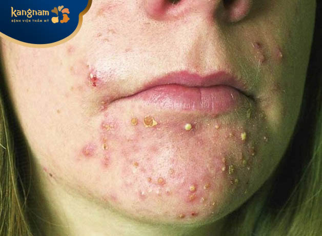 Mụn trứng cá kèm mủ bên trong