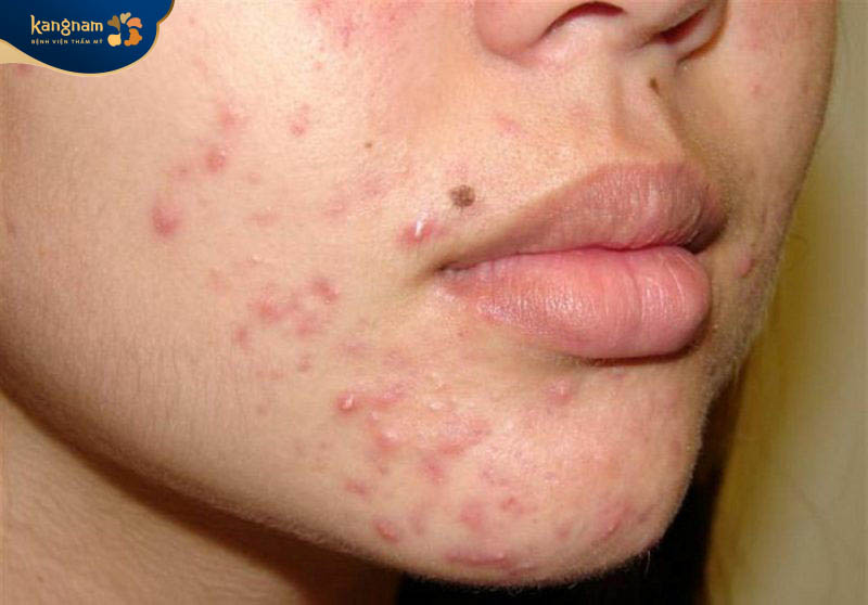 Mụn trứng cá không thể tự hết thậm chí còn phát triển nặng nề hơn