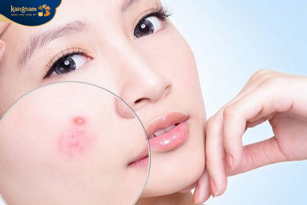Bạn nên điều trị mụn sớm thay vì chờ mụn tự hết