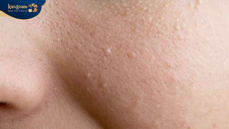 Mụn sưng tấy, gồ ghề, có màu trắng