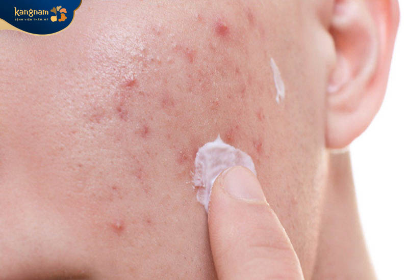 Sử dụng thuốc bôi trị mụn