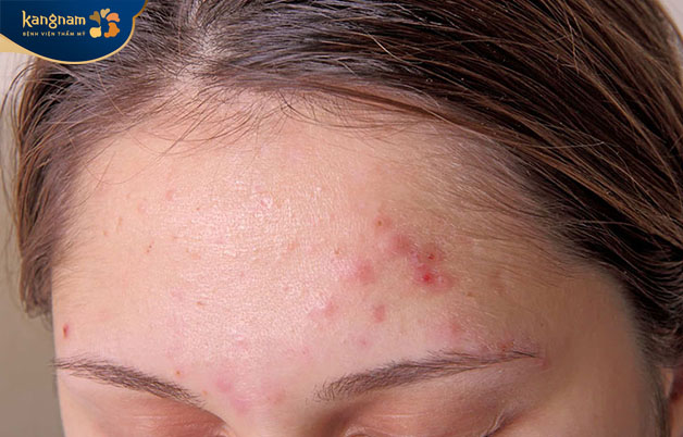 Những nốt mụn nổi rõ trên da và hơi sưng tấy