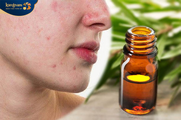 Tinh dầu tràm trà có tính kháng viêm rất hữu ích để điều trị mụn