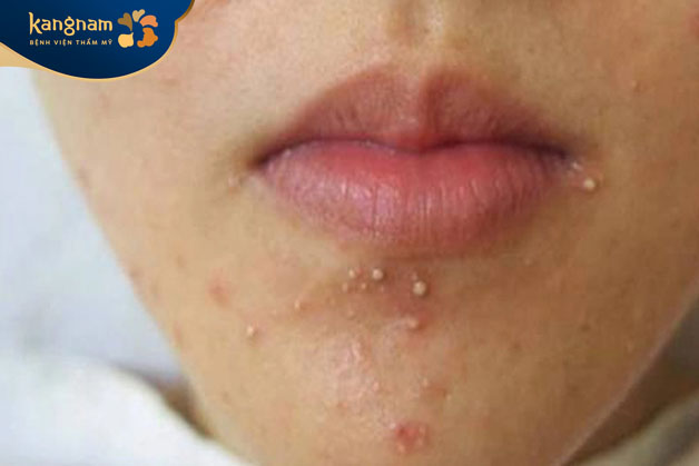 Mụn trứng cá mọc ở vùng môi có thể tự hết theo thời gian