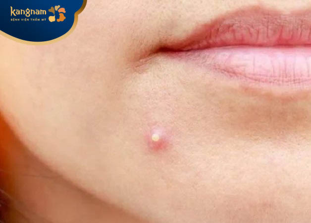 Mủ bên trong nhân mụn